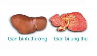 Tầm soát ung thư Gan Tụy